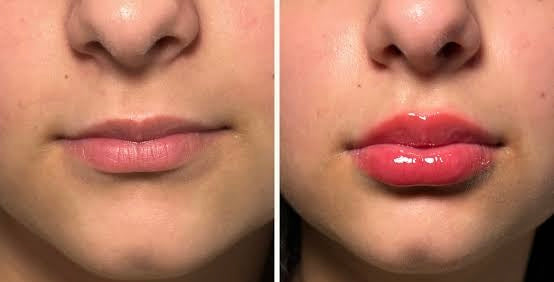Extreme 3ML Lip Plumper
